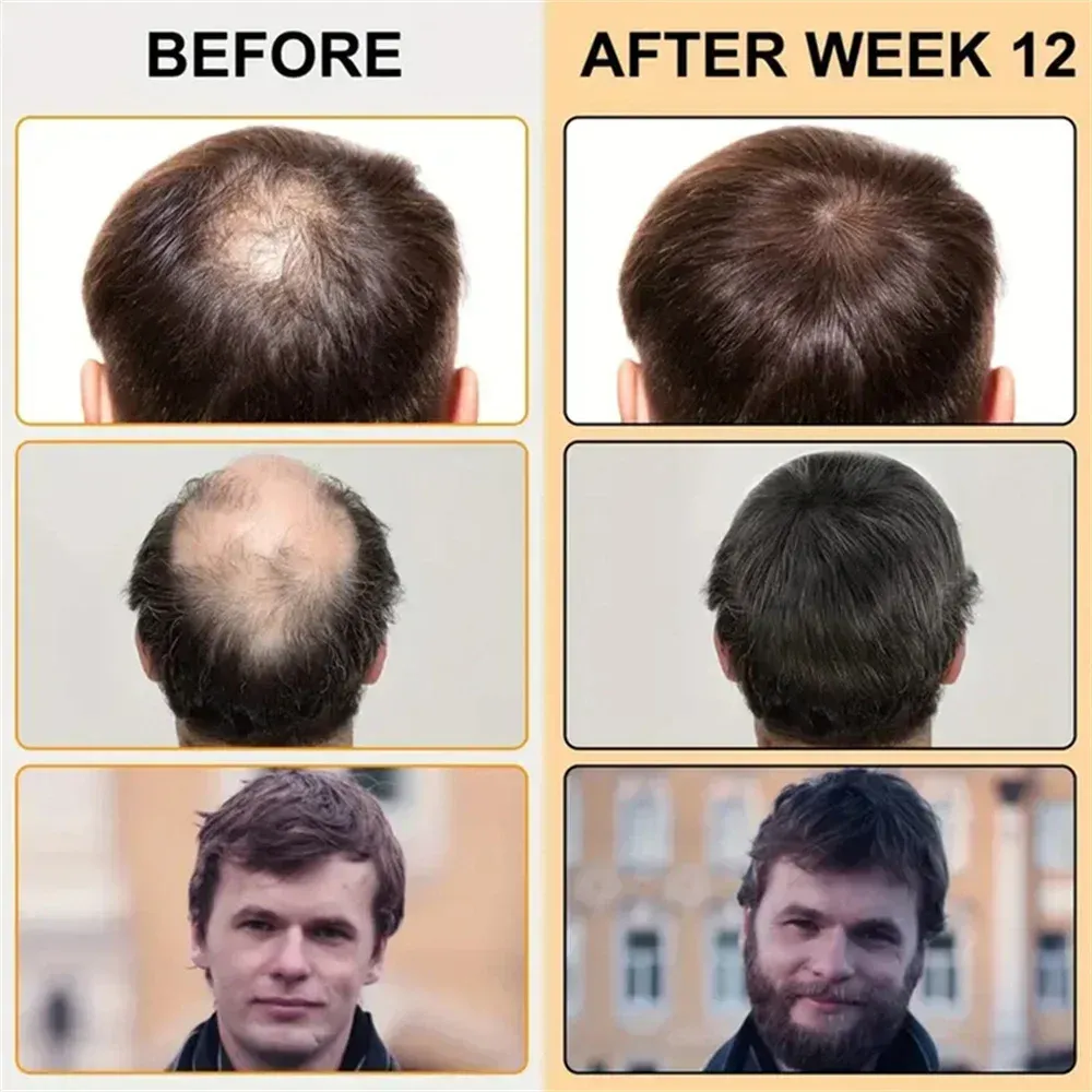 Biotin Hair Growth Oil for Men - Fast Scalp Treatment for Anti Hair Loss, Promotes Thicker, Stronger Hair Growth with Roller Massage Applicator showcase 1