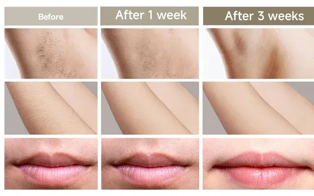 Professional IPL Laser Hair Remover for Women - Painless Permanent Epilator with 999999 Flashes, Home Use Device for Face & Bikini, Multiple Plug Options showcase 11